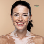 Vitiligo white patches on skin representing depigmentation condition treated naturally with Ayurvedic herbs