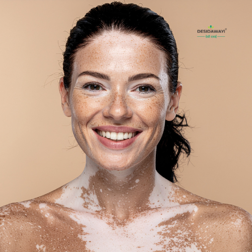 Vitiligo white patches on skin representing depigmentation condition treated naturally with Ayurvedic herbs